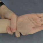 Steinberg Wrist Sign