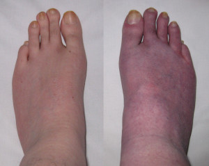 My feet, before and after 10 minutes standing, showing venous pooling.